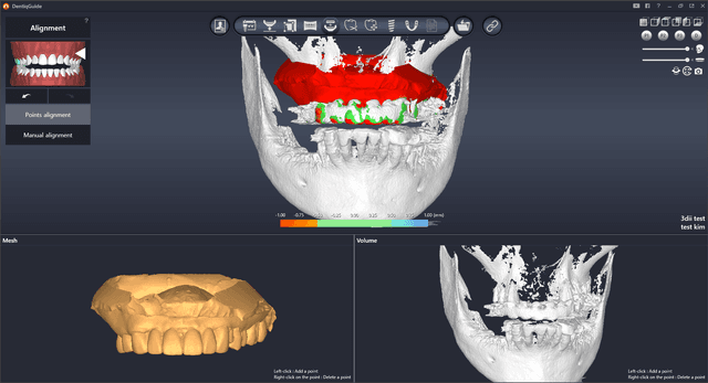 Nerve Canal Detection