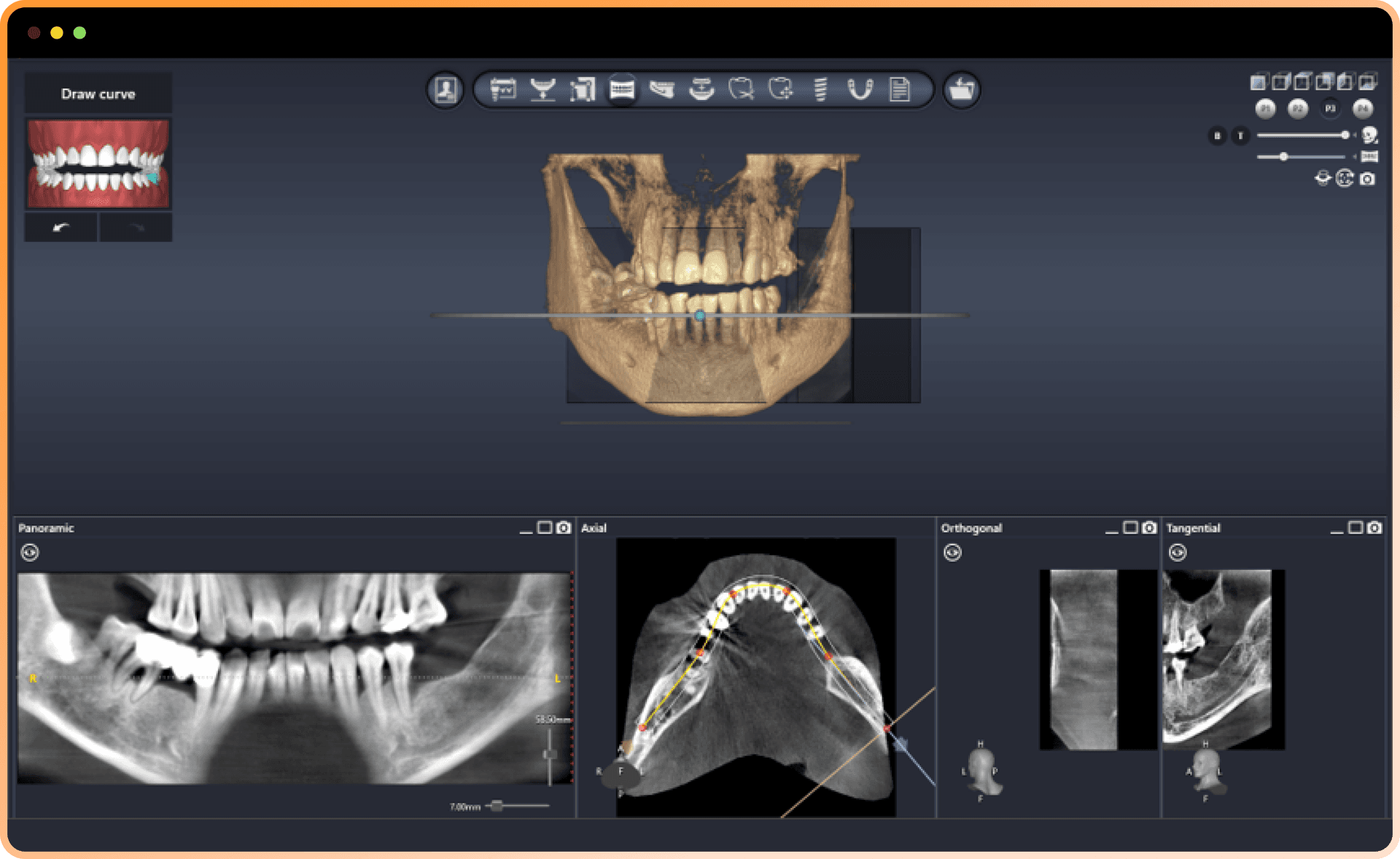 DentiqGuide Software Interface